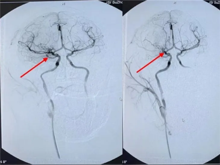 Stoke ve Beyin İskemisinin Orta Serebral Arter Tıkanıklığı (MCAO) NHP Modeli